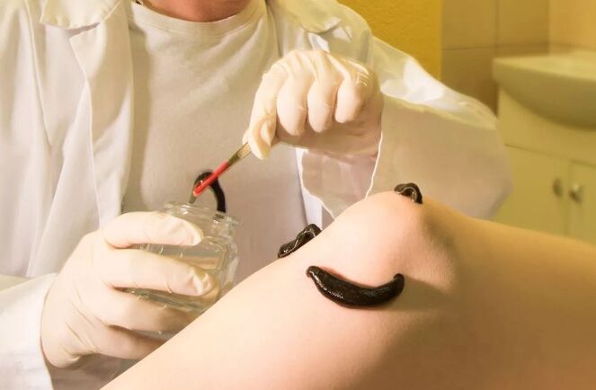 Hirudotherapie fir Variosen Venen