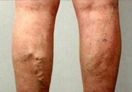 Thrombombolismus