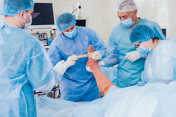 Varicosis Operatioun