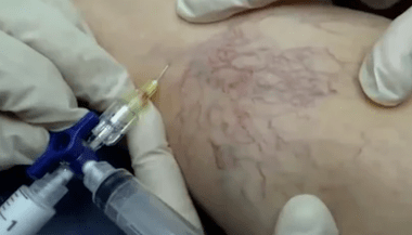 Sklerotherapie fir Krampfadern