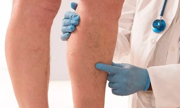Dokter ënnersicht Been fir Krampfadern